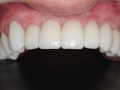 dental implants with fixed bridge- implant dentist bethesda